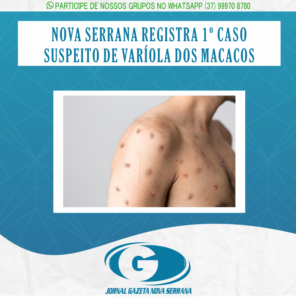 NOVA SERRANA REGISTRA 1º CASO SUSPEITO DE VARÍOLA DOS MACACOS