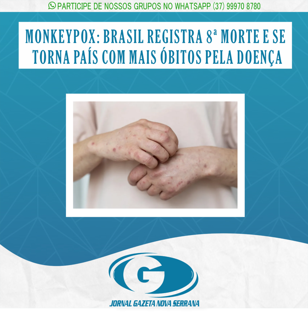 MONKEYPOX: BRASIL REGISTRA 8ª MORTE E SE TORNA PAÍS COM MAIS ÓBITOS PELA DOENÇA